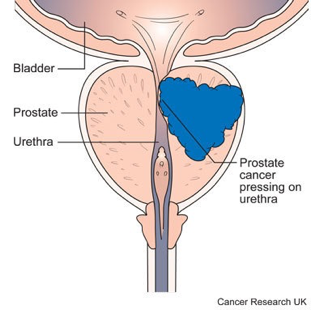 stage 4 prostate cancer no symptoms