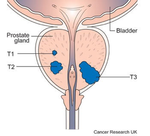 prostate cancer stages symptoms
