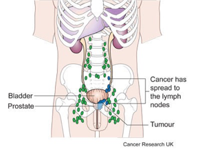 prostate cancer with metastasis to lymph nodes