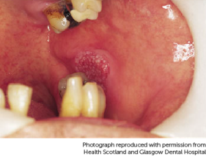 hpv throat cancer destroy diseases